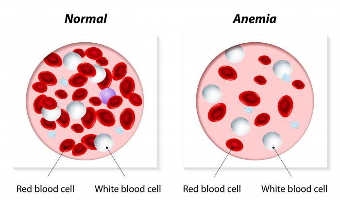 anemia tünetei hipertónia és magas vérnyomás