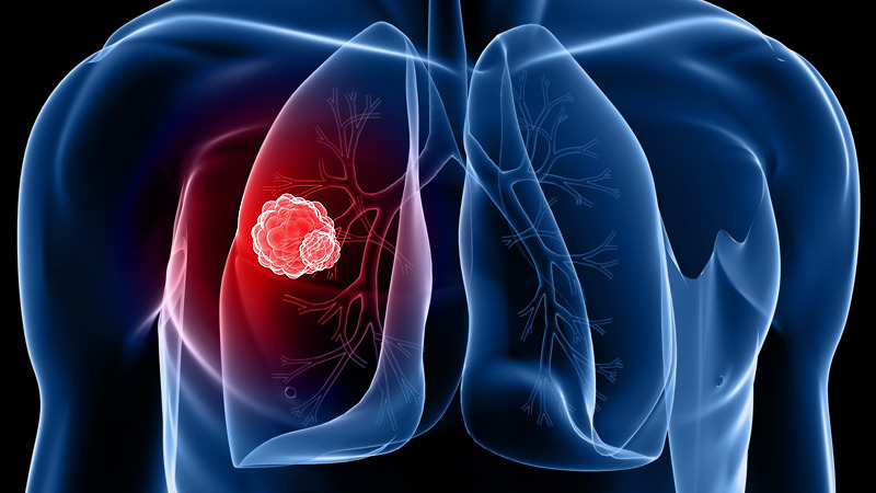 mik a tüdőrák tünetei humán papillomavírus változásai vannak jelen
